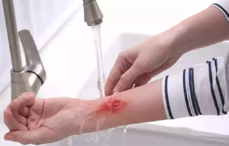 दीये-पटाखे जलाते जल जाए हाथ-पैर, तो तुरंत करें ये 5 घरेलू उपचार