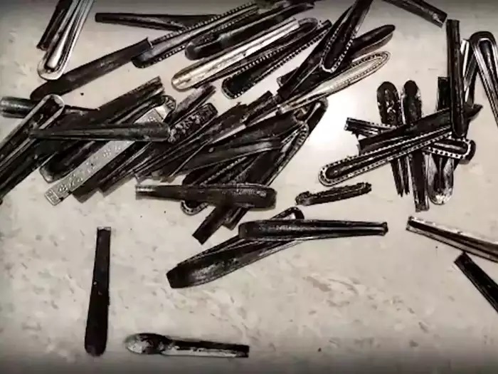 पेट से निकले 5 दर्जन से ज्यादा चम्मच 