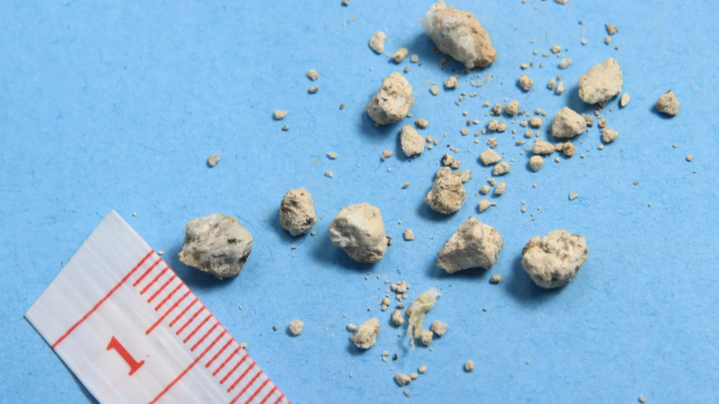 154 Stones in Kidney: डायबिटीज के मरीज के गुर्दे से निकाली गई 154 पथरी, सबसे बड़ी पथरी 62x39 मिलीमीटर की 